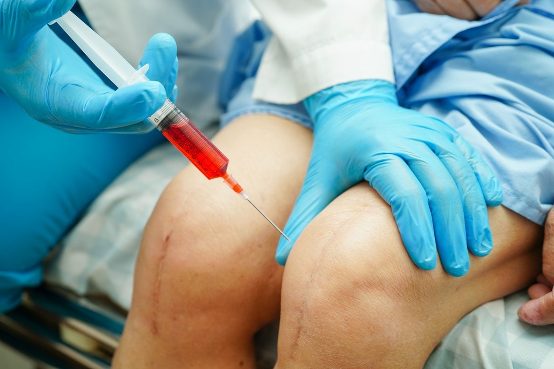 lekarz ostrzykuje kolano kobiety kwasem bogatopłytkowym